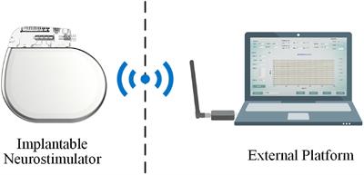 Removal of Electrocardiogram Artifacts From Local Field Potentials Recorded by Sensing-Enabled Neurostimulator